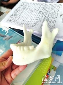 福州:17岁<em>美少女</em>下巴被肿瘤吃掉 <em>3D</em>打印私人