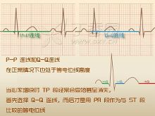 漫画心电图:ST?段读图四步法
