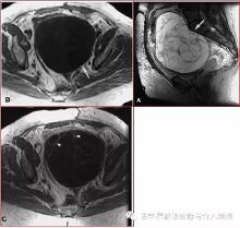 MRI说，这9大女性生殖系统疾病归我管!【8】-新闻频道-手机搜狐