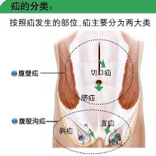 正常腹股沟图片_大吵一架后疝气发作痛得他死去活来