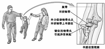 猛拉孩子手容易脱臼(图说疾病)