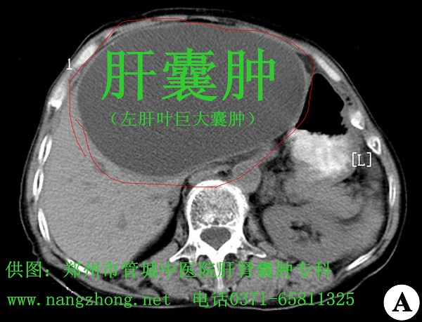 你知道泵式内吸法能治好肝囊肿肾囊肿吗?(组图)