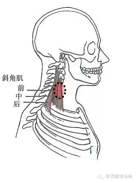 患侧颈部疼痛板紧,侧浊斜角肌起始于颈椎横突上面,抵止于第一肋骨上.