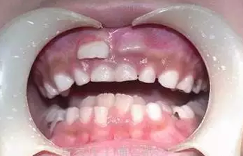 生活贴丨孩子长出双层牙的真实原因
