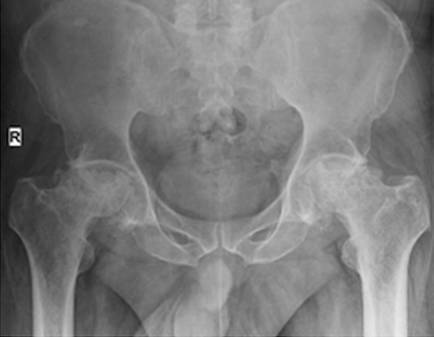 股骨头坏死ct报告模板 BMJ:年轻人腹股沟持续
