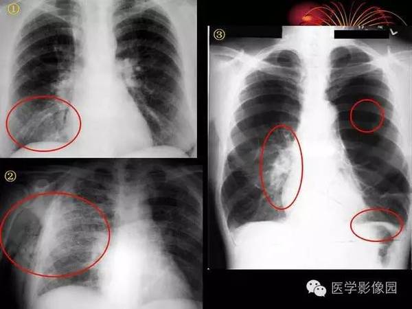 胸片阅读技巧超全解析!