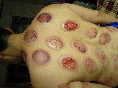 拔罐拔出水疱说明体内湿气出来了?别扯了! 学会这几种杠铃瘦身操，反手摸肚脐不是梦_139资讯吧