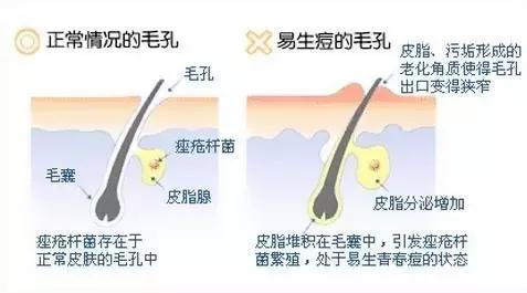 皮脂腺堵塞就长痘痘,那皮脂腺到底是什么?