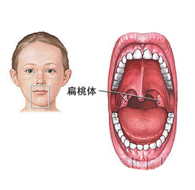 一,扁桃体发炎的病因病机: 扁桃体炎是儿童和青少年的常见病.