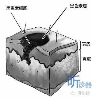 指甲盖里小黑痣,竟是黑色素瘤?