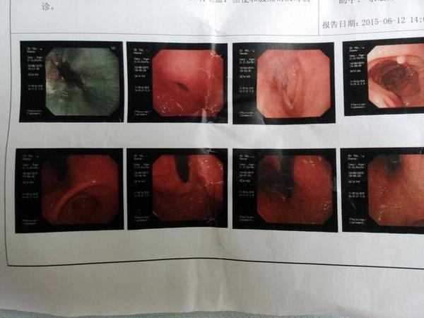 慢性胃炎有很多的临床症状,主要表现为食欲减退,恶心,嗳气,上腹部饱胀