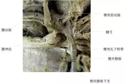 横突孔韧带可分为横突孔上韧带,横突孔下韧带,以横突孔下韧带最多见.