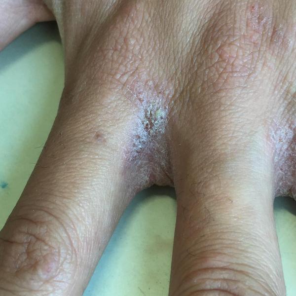 疥疮是通过 疥虫(也有叫疥螨)引起的瘙痒性皮肤病 2.