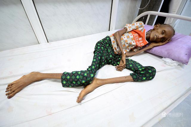 也门18岁姑娘因营养不良骨瘦如柴