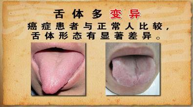 (2)舌苔:研究显示,白滑苔中癌症患者为正常人56.