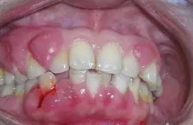 牙周炎有什么症状?