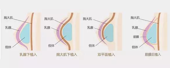美莱采取四大假体植入方式