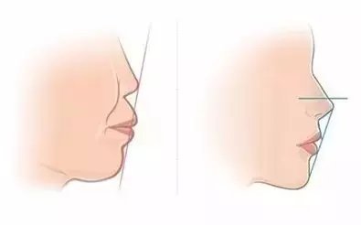 例如暴牙这种病例, 嘴唇由于门牙向后移动会变得较易牢固,这样门齿就