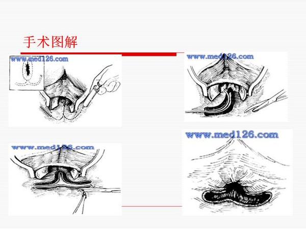 得了肛瘘如何诊治?(附示意图)