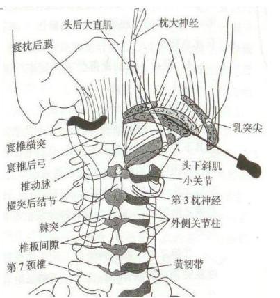 枕大神经痛的治疗有哪些?