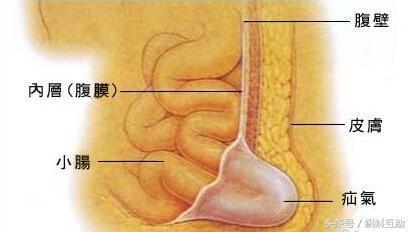手术——疝气最好的治疗方法