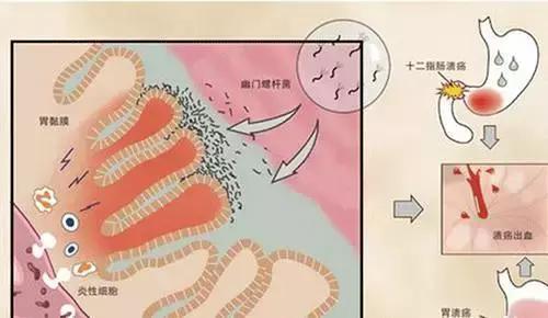 幽门螺旋杆菌保险告知 幽门螺旋杆菌症状表现