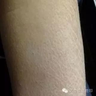 冬季皮肤干燥瘙痒还起皮屑