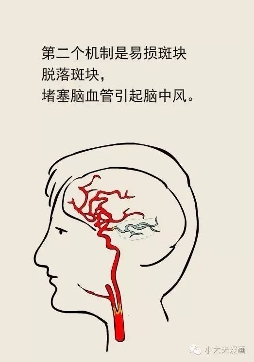 健康关注|发现颈动脉斑块,需要注意哪些问题?