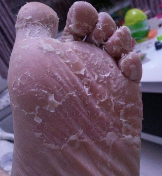 是因为脚气一般都是有脚气真菌引起的,而真菌一般存在于皮肤的真皮层