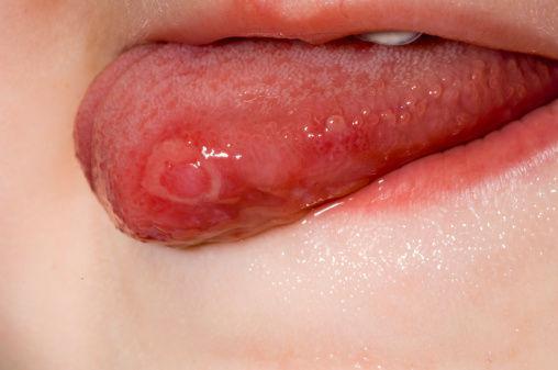 原标题:厦门女子舌头溃疡变舌癌舌头被迫切掉一半 看到这样的新闻