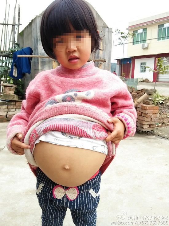 12岁女童肚子大,以为怀孕,竟是得了一种癌!