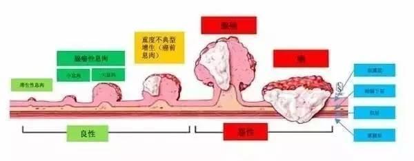 来看看从肠息肉到肠癌究竟隔了多远!