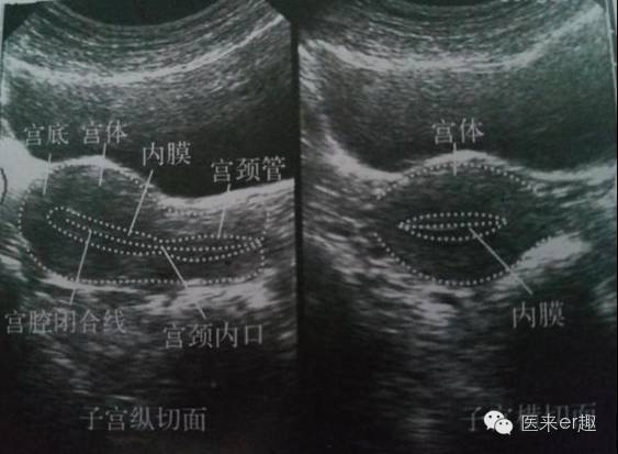 b超图解:常见妇科疾病典型超声表现