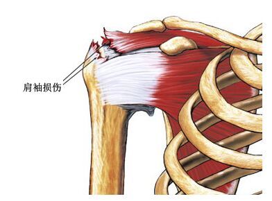 治疗方面,虽然肩袖钙化性肌腱炎有很强的自愈倾向,但是这个自愈的过程