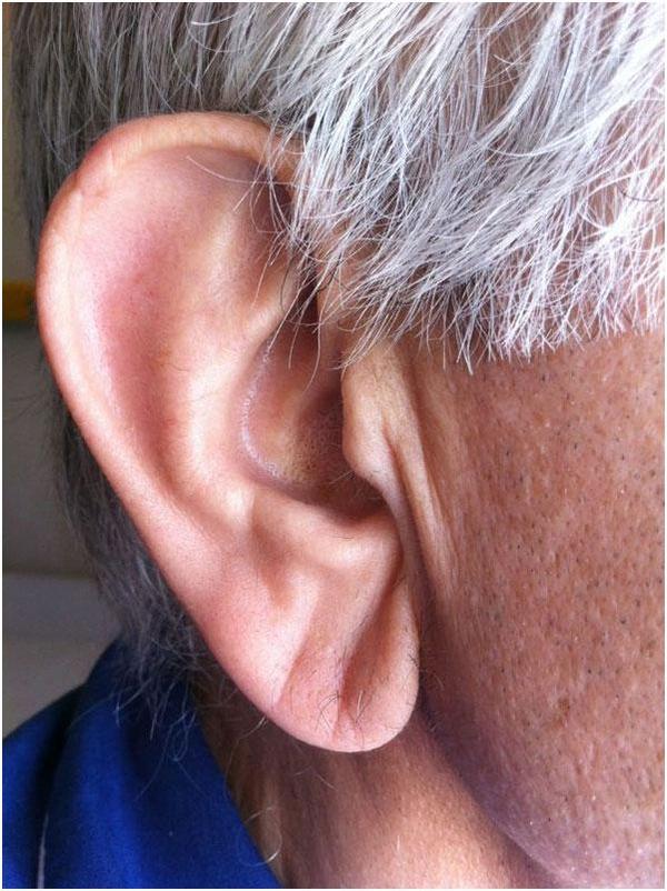2.耳垂出现褶皱,或是冠心病前兆