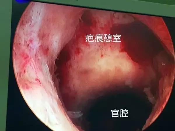 如图所示:外面看到的洞口就是憩室,里面的腔才是真正的宫腔.
