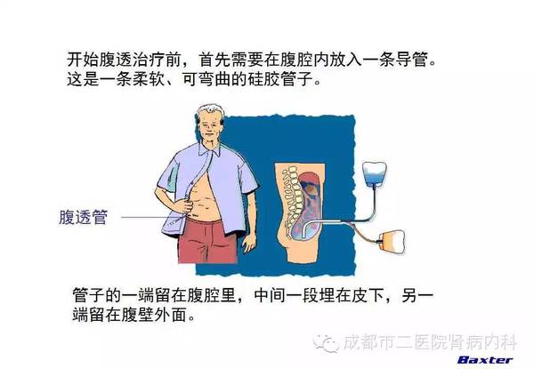 血液透析和腹膜透析,哪个适合我?