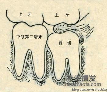 但是,智齿是牙列中最后萌出的牙 智齿,学名第三大臼齿,俗称智慧齿,立