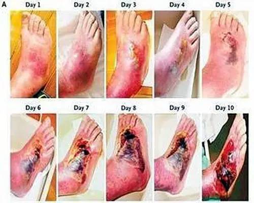 住院糖尿病足患者临床诊治指南