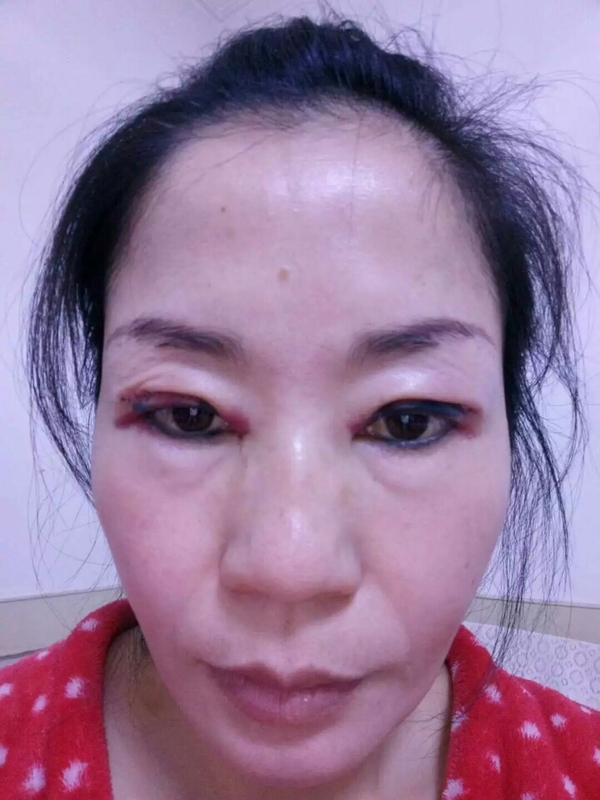 银川亮丽女人美容吴凯伦双眼皮美丽嬗变记