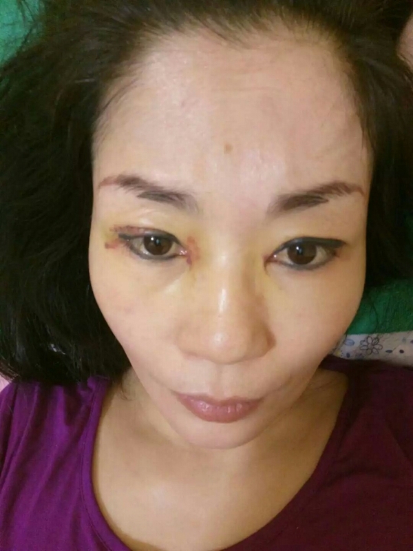 手术第七天,拆线."线一拆,眼睛立马舒服了." 手术第十天,顾盼生辉了.