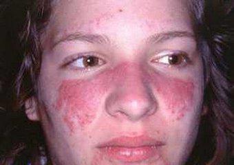 4,系统性红斑狼疮面色 患者表现为面部的蝶形红斑,即对称性分布于双侧