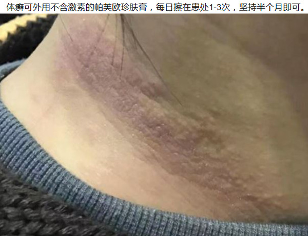 体癣能自愈吗,日常护理效果好?