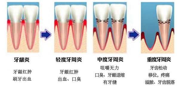 牙周炎真的治不好吗?