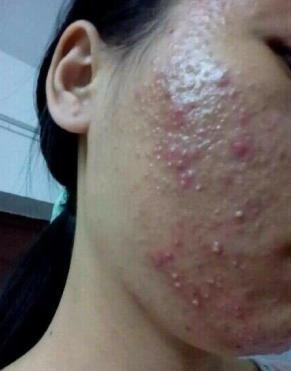 满脸痘痘不仅极大影响了外貌,其红肿发炎还会带来肉体上的疼痛,让很多