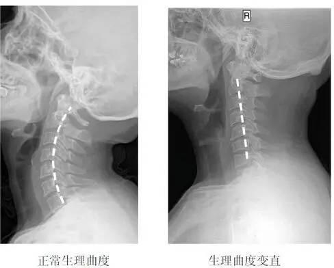 脖子筋疼痛有小妙招