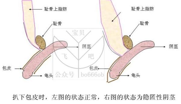 宝宝下身很红鸡鸡上长红屁屁肿么办?