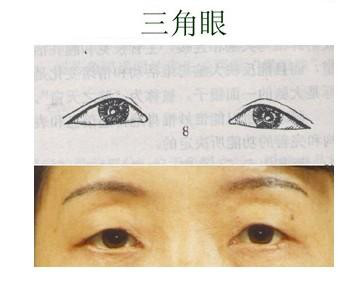 美诗沁专家张晋宝:出现三角眼如何解决?