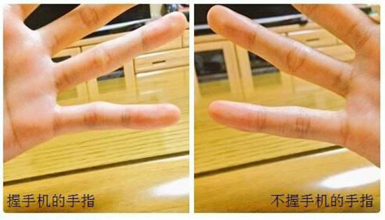 玩手机,手指会变畸形?