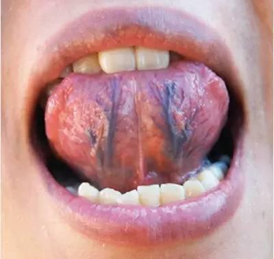 舌下长紫筋,血管有危险!每天喝它,血管干干净净